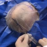 CHM de Santo André realiza primeira cirurgia cerebral com paciente acordada